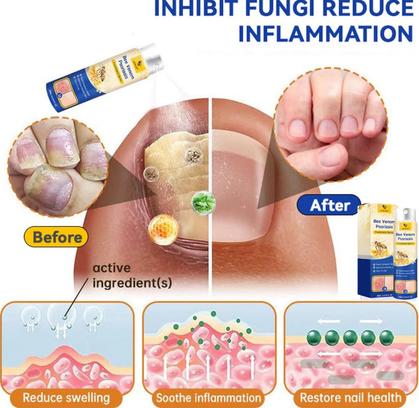 LAST DAY OF DISCOUNT 🔥 BeeVenom Psoriasis Care Spray Pro